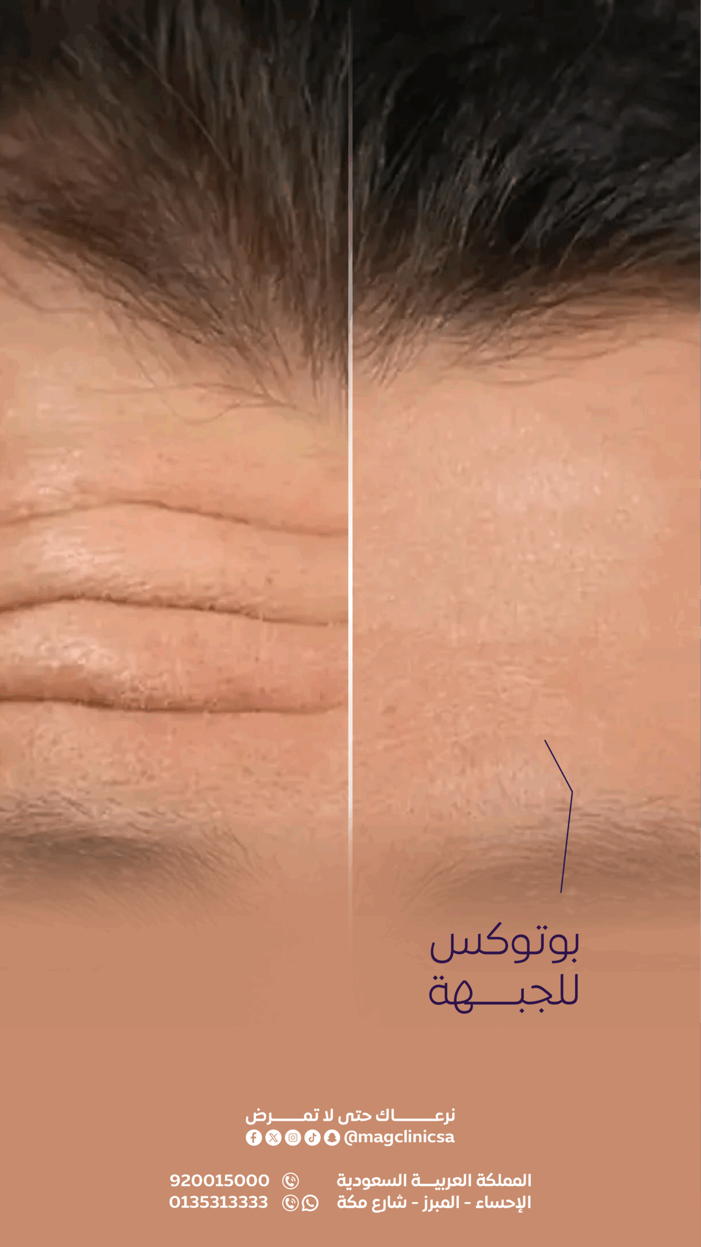 Botox B&A
