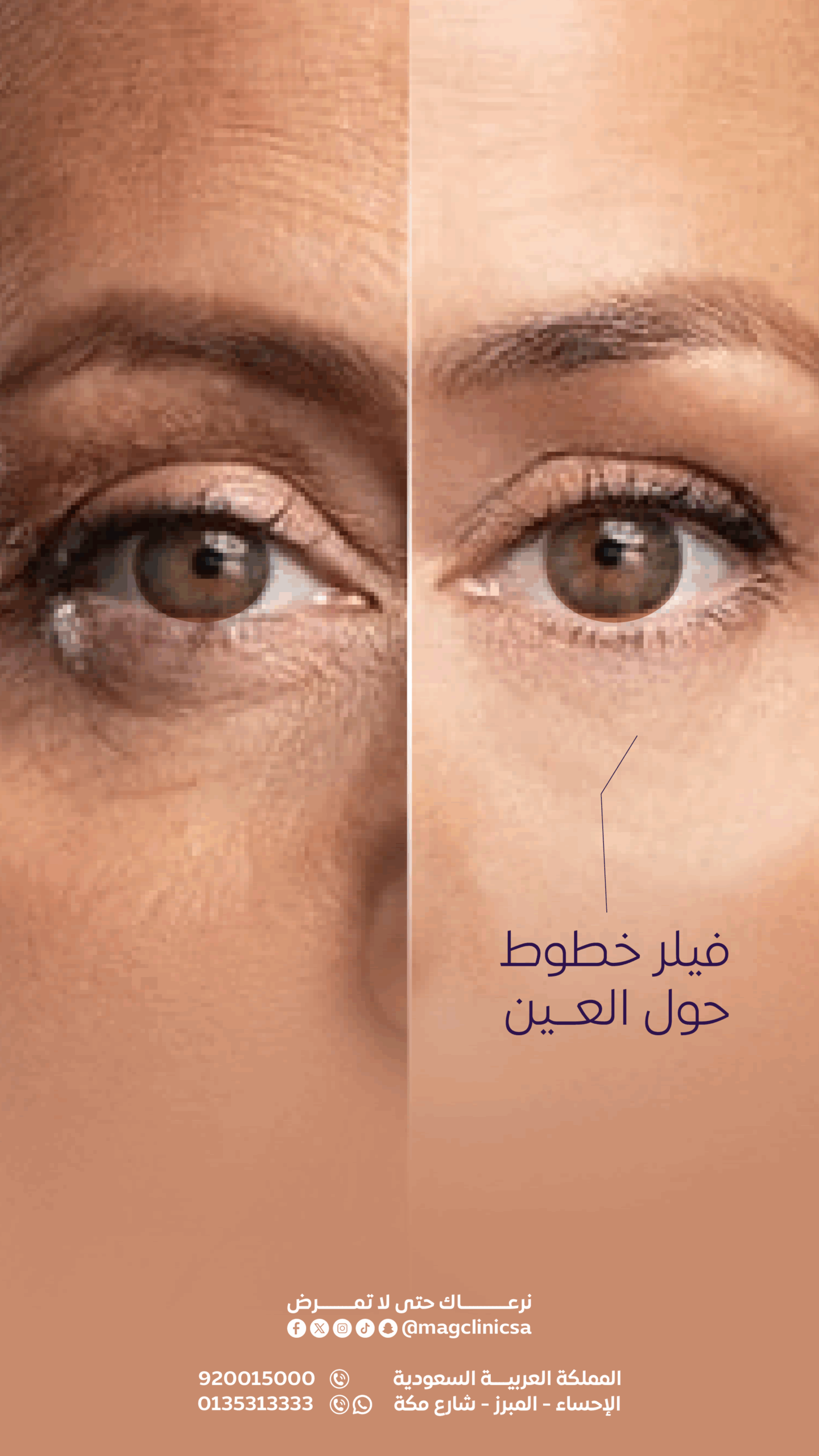 Filler B&A