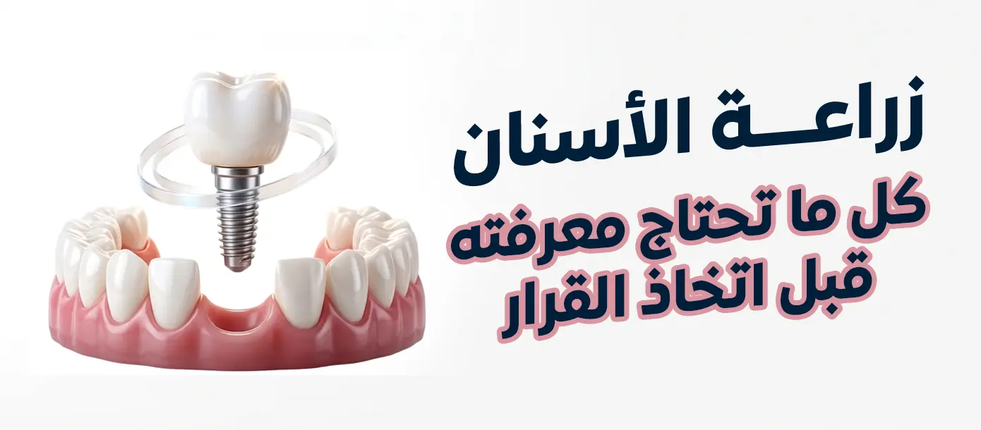 زراعة الأسنان وتعويض الأسنان المفقودة